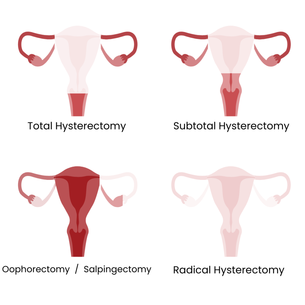 Types of hysterectomies