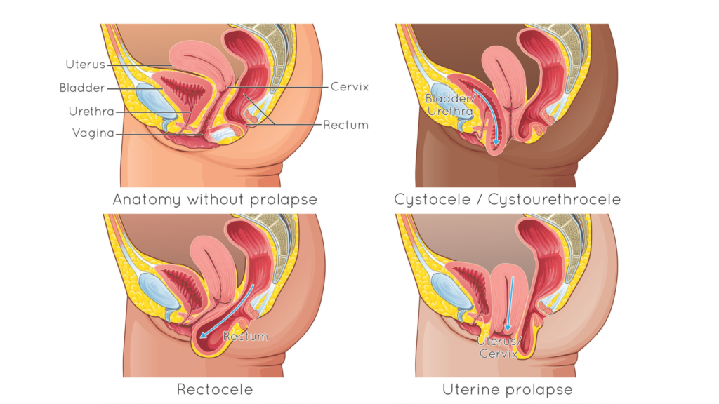 diagrams of types of pelvic organ prolapse