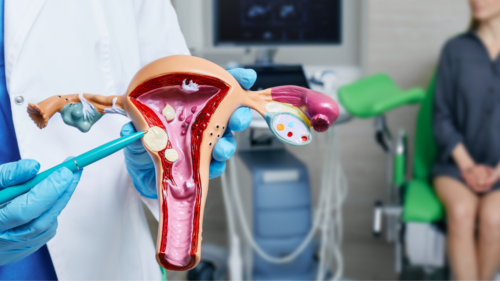 doctor pointing to uterine fibroids