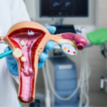 doctor pointing to uterine fibroids