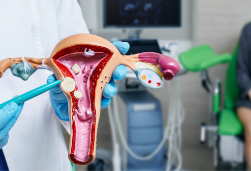 doctor pointing to uterine fibroids