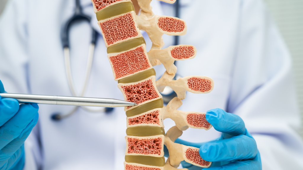 osteoporosis of the spine spinal column with bone loss