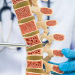 osteoporosis of the spine spinal column with bone loss