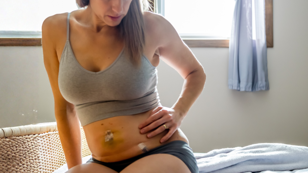 woman in post-operative recovery after surgery with abdominal laparoscopic robotic incisions healing