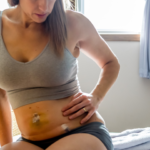 woman in post-operative recovery after surgery with abdominal laparoscopic robotic incisions healing
