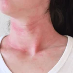 histamine intolerace allergic reaction mast cell activation flushed face neck