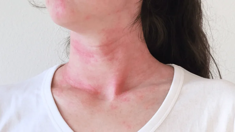 histamine intolerace allergic reaction mast cell activation flushed face neck