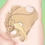 sacral nerve modulation neuromodulation stimulation interstim