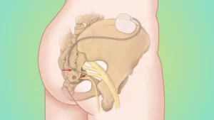 sacral nerve modulation neuromodulation stimulation interstim